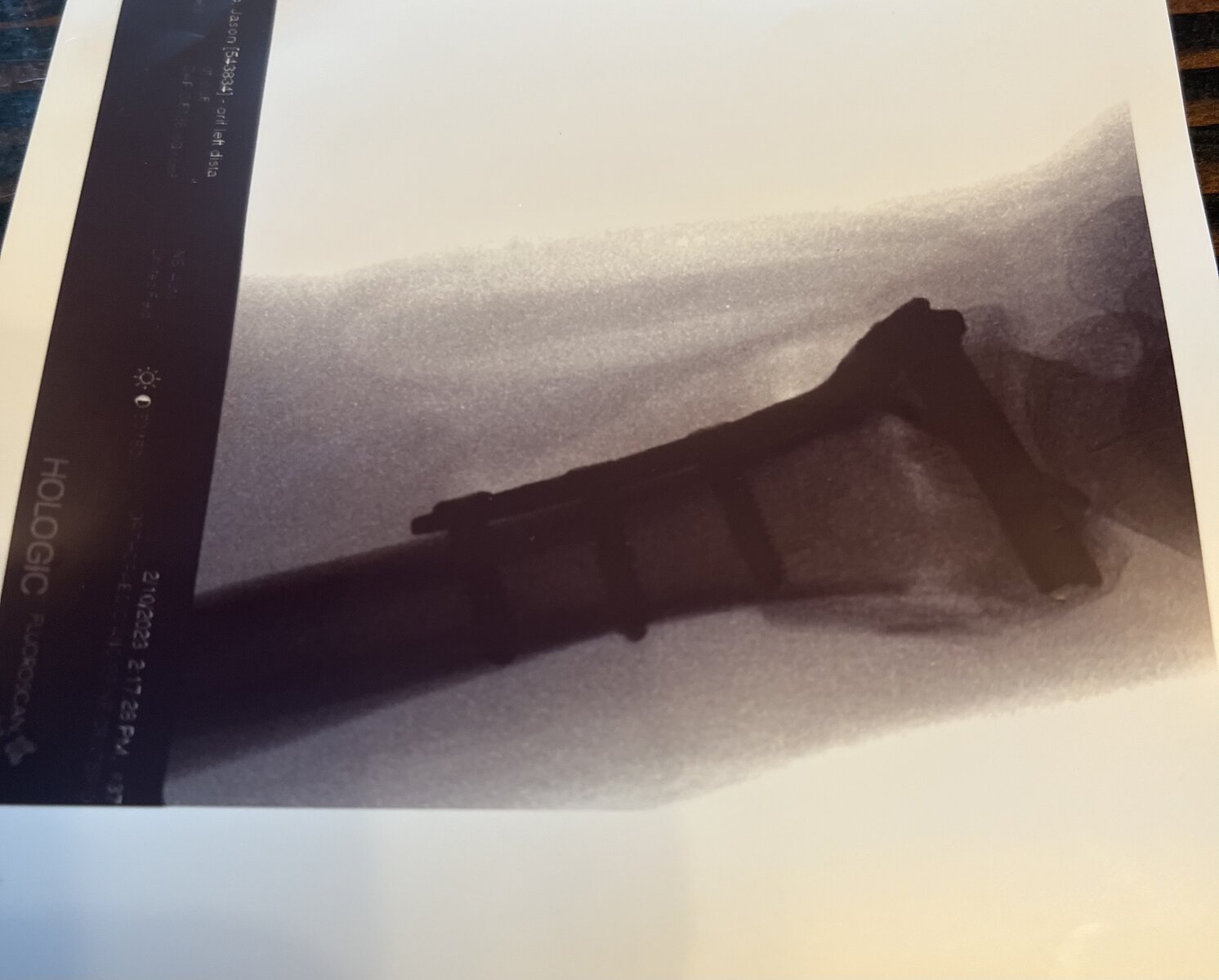 Forgot to post for a couple years… Whatta ride. ⚠️ Trigger warning: broken  bone X-rays if you're into that sorta thing. ⚠️