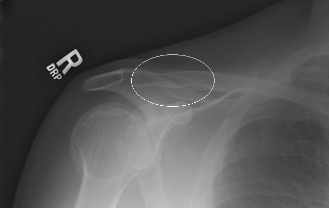 collar bone.JPG